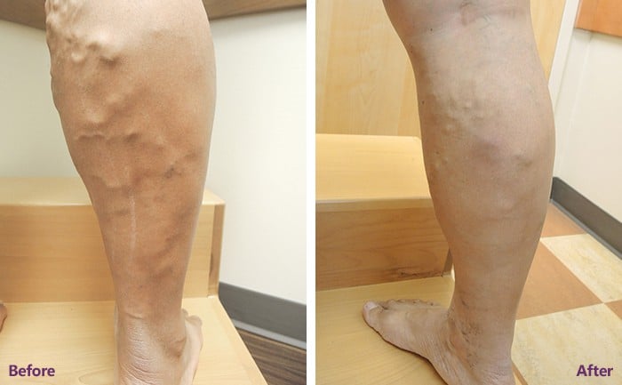 Chronic-venous-insufficiency-Before-After-Spider-and-Varicose-Vein-Treatment.jpg